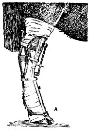 Рис. 5. Иммобилизирующая повязка системы Колонка для тазовой конечности