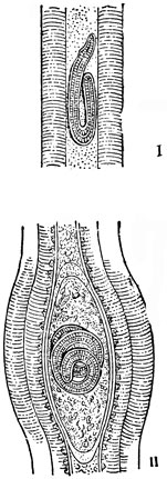 Рис. 2. Личинки трихинеллы: I - личинка, внедрившаяся в мышцы; II - личинка в капсуле